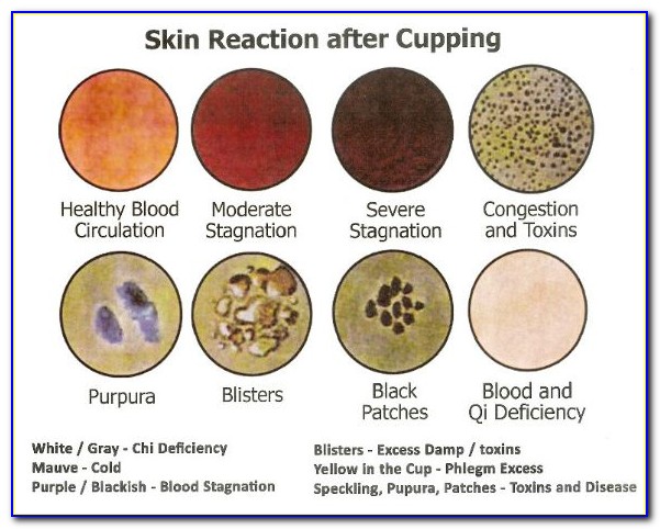 Cupping Therapy Certification Nyc
