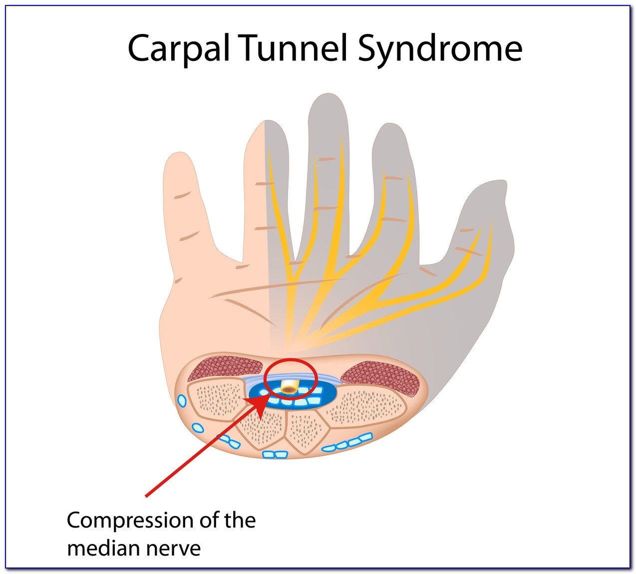 Carpal Tunnel Surgery Diagram