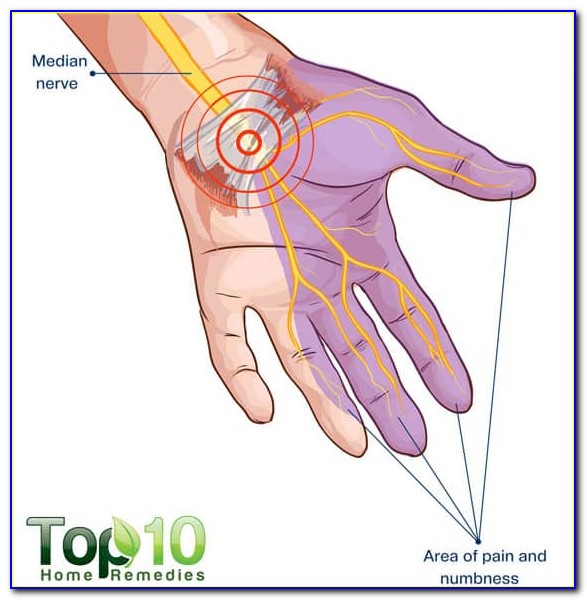Carpal Tunnel Syndrome Diagram