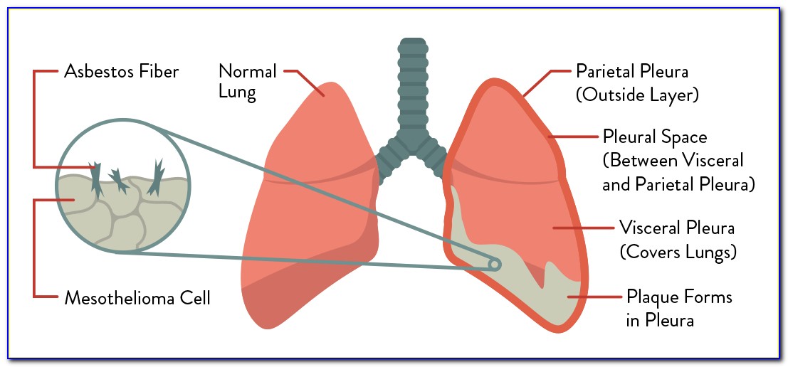 Lung Cancer Labeled Diagram