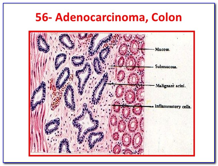 Adenocarcinoma Histology Diagram