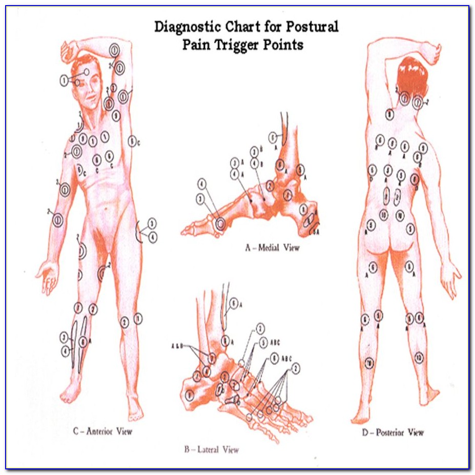Fibromyalgia Trigger Points Diagram
