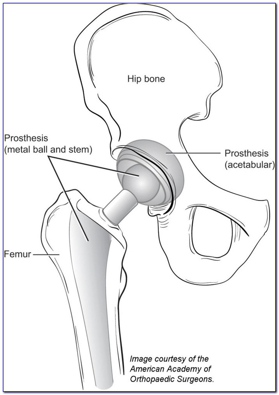 Hip Replacement Surgery Diagram