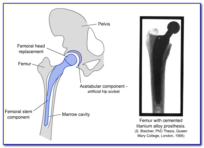 Hip Replacement Surgery Illustration